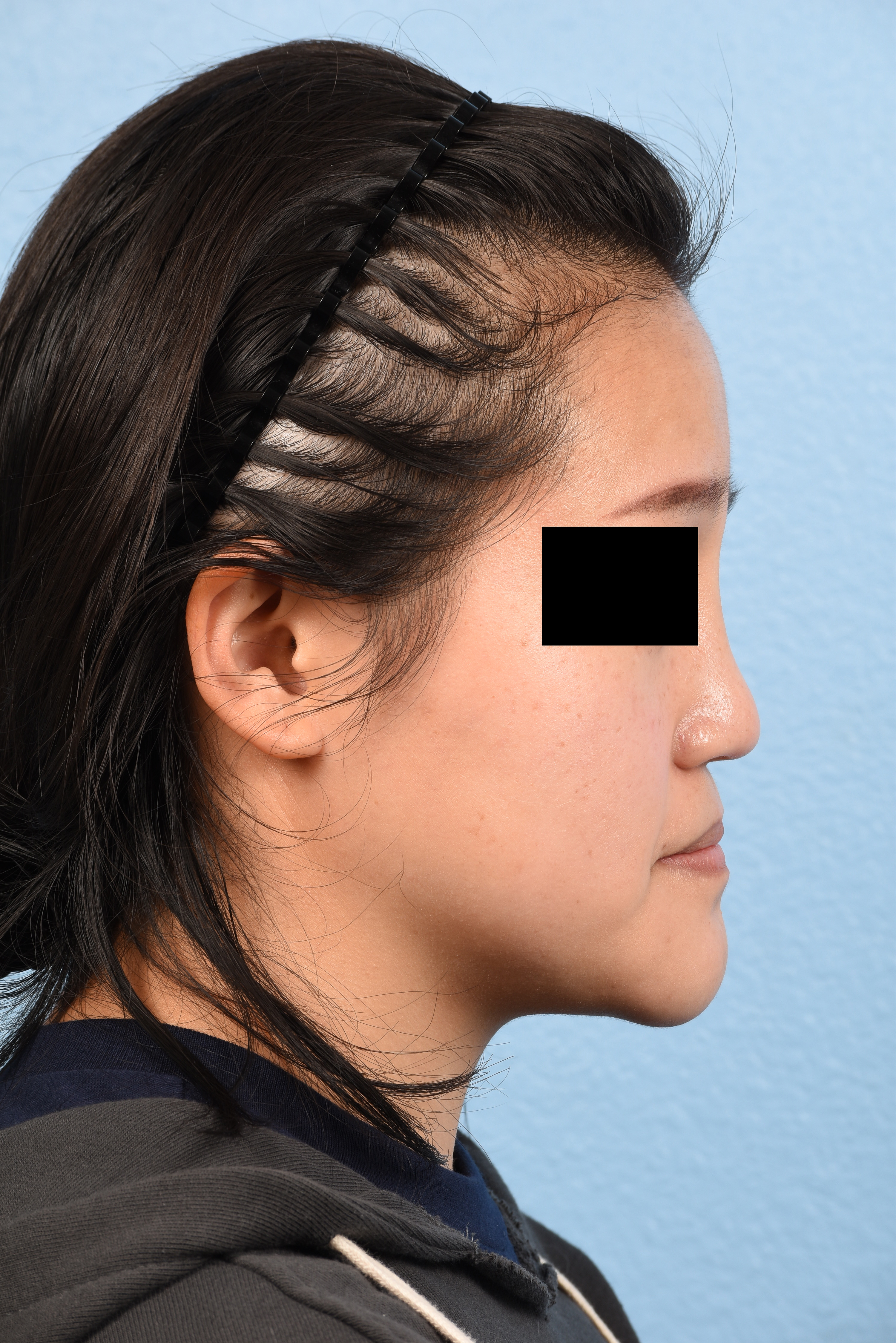 Hidden Patients Before & After Gallery - Patient 893076 - Image 1