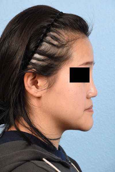 Rhinoplasty Before & After Gallery - Patient 172159 - Image 1