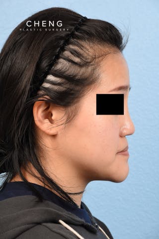 Hidden Patients Before & After Gallery - Patient 893076 - Image 1