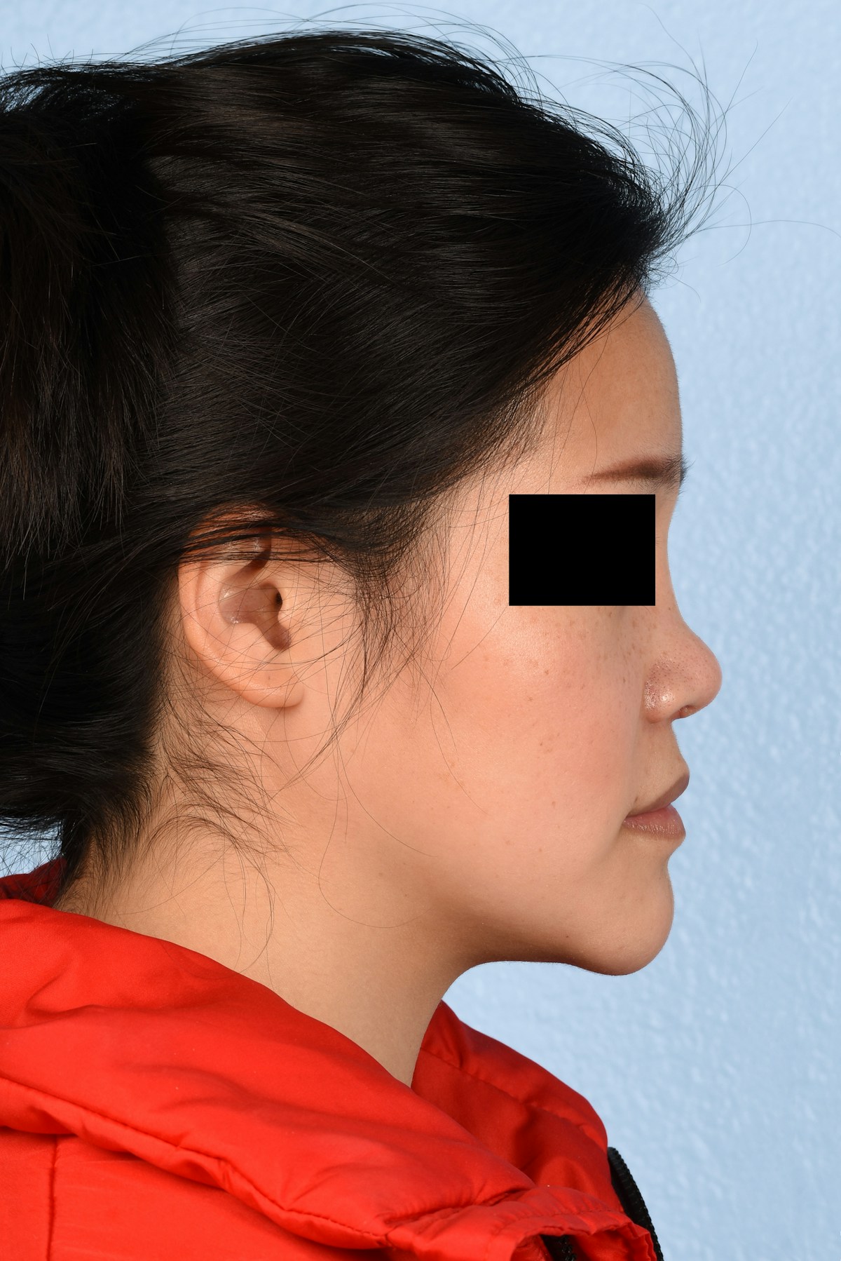 Rhinoplasty Before & After Gallery - Patient 172159 - Image 2