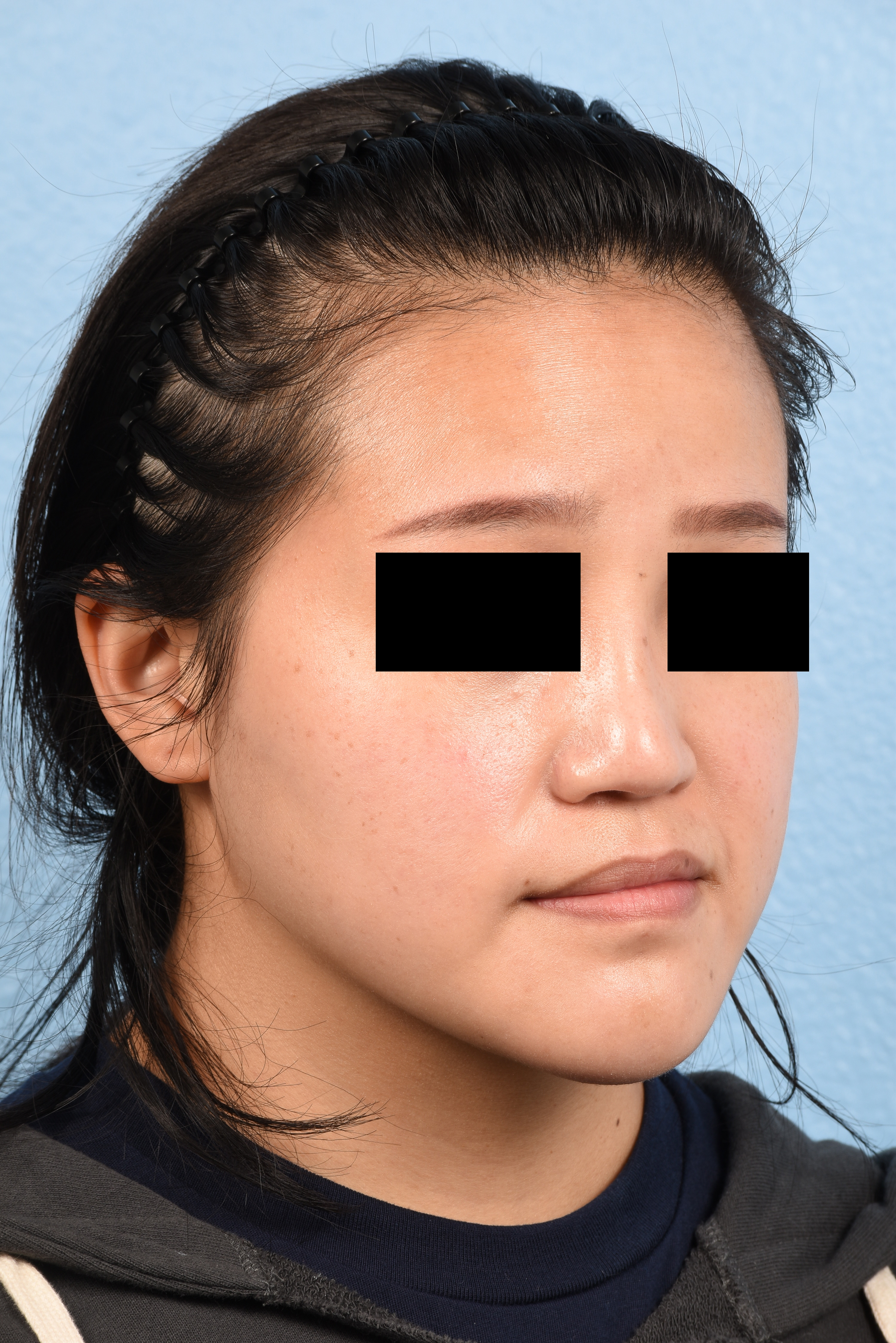 Hidden Patients Before & After Gallery - Patient 893076 - Image 3