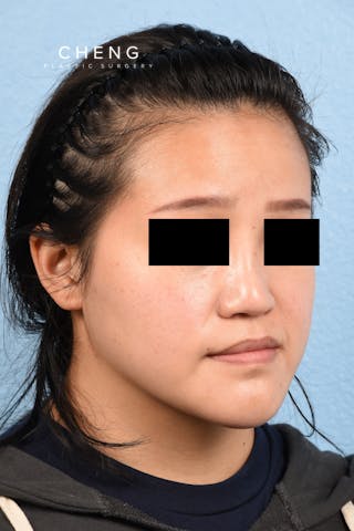 Hidden Patients Before & After Gallery - Patient 893076 - Image 3