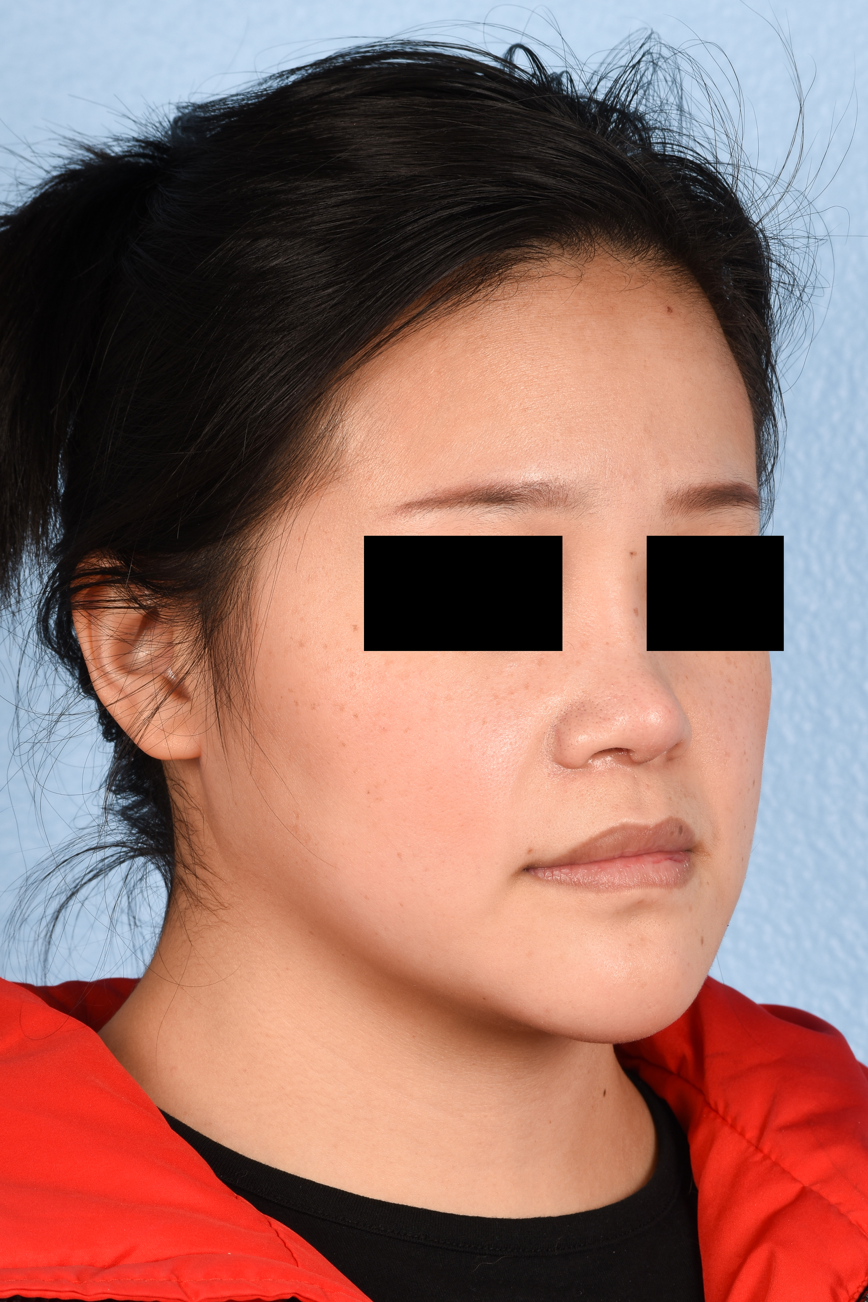 Hidden Patients Before & After Gallery - Patient 893076 - Image 4