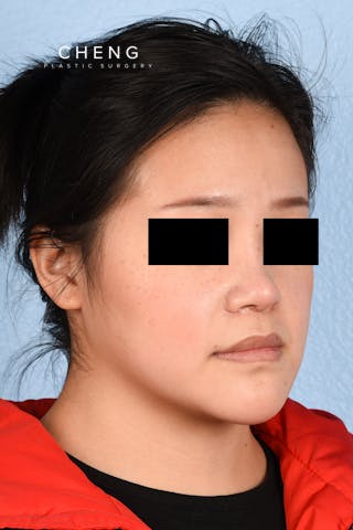 Hidden Patients Before & After Gallery - Patient 893076 - Image 4