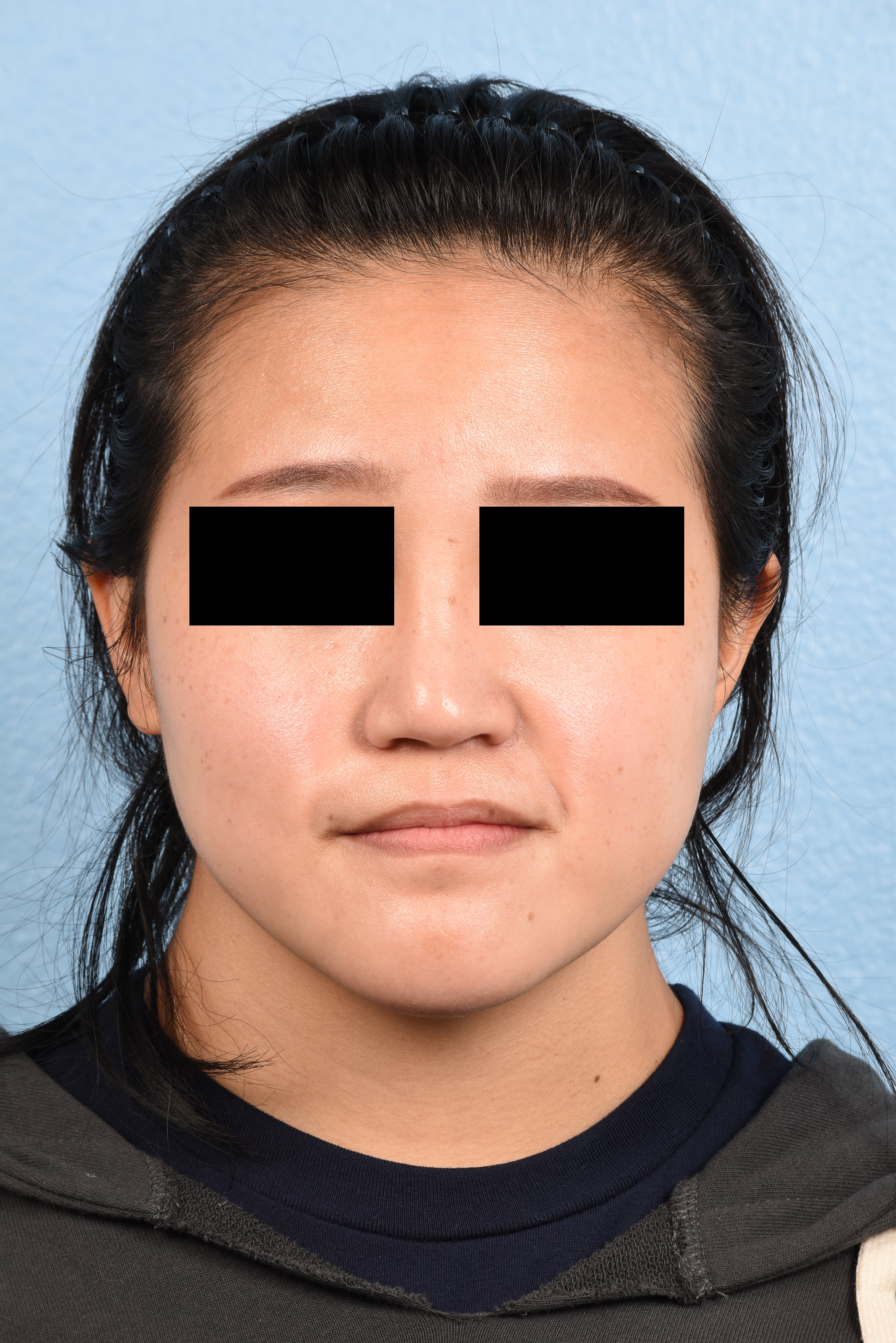 Hidden Patients Before & After Gallery - Patient 893076 - Image 5