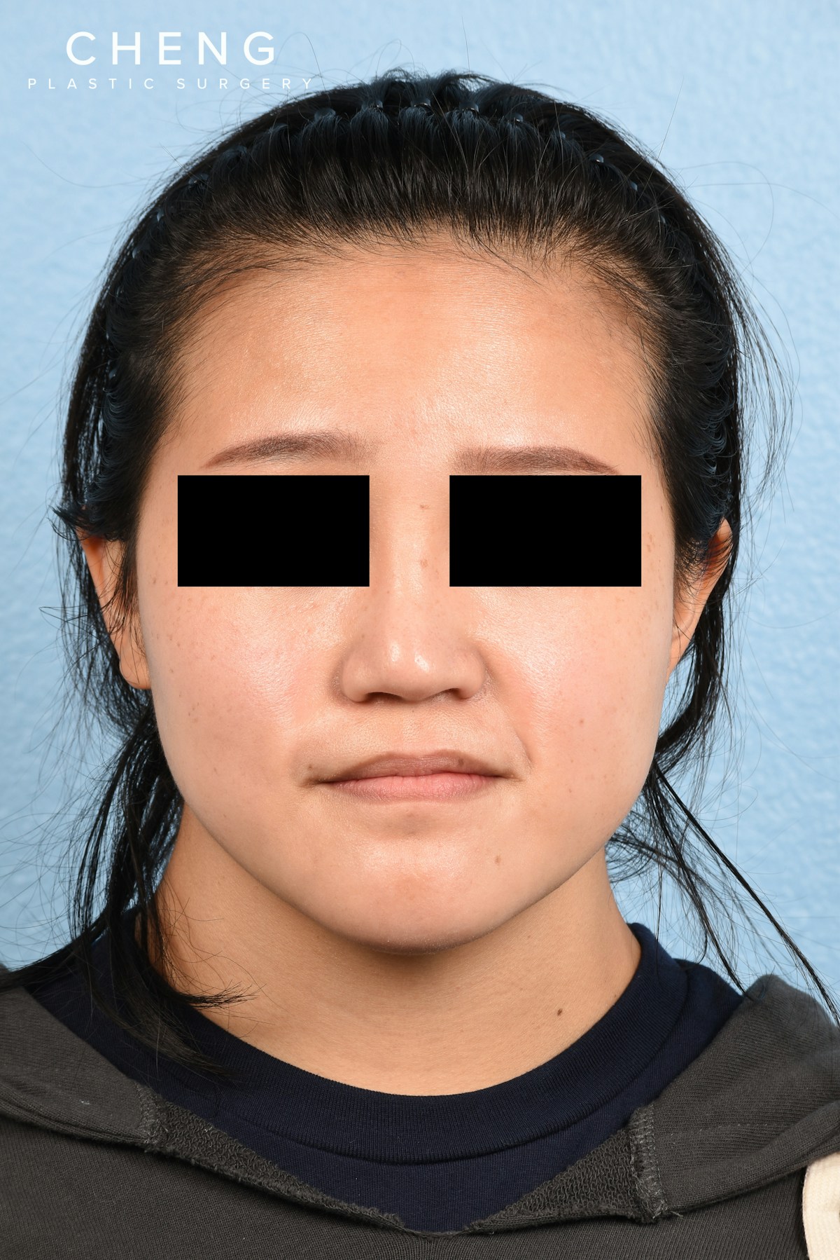 Hidden Patients Before & After Gallery - Patient 893076 - Image 5