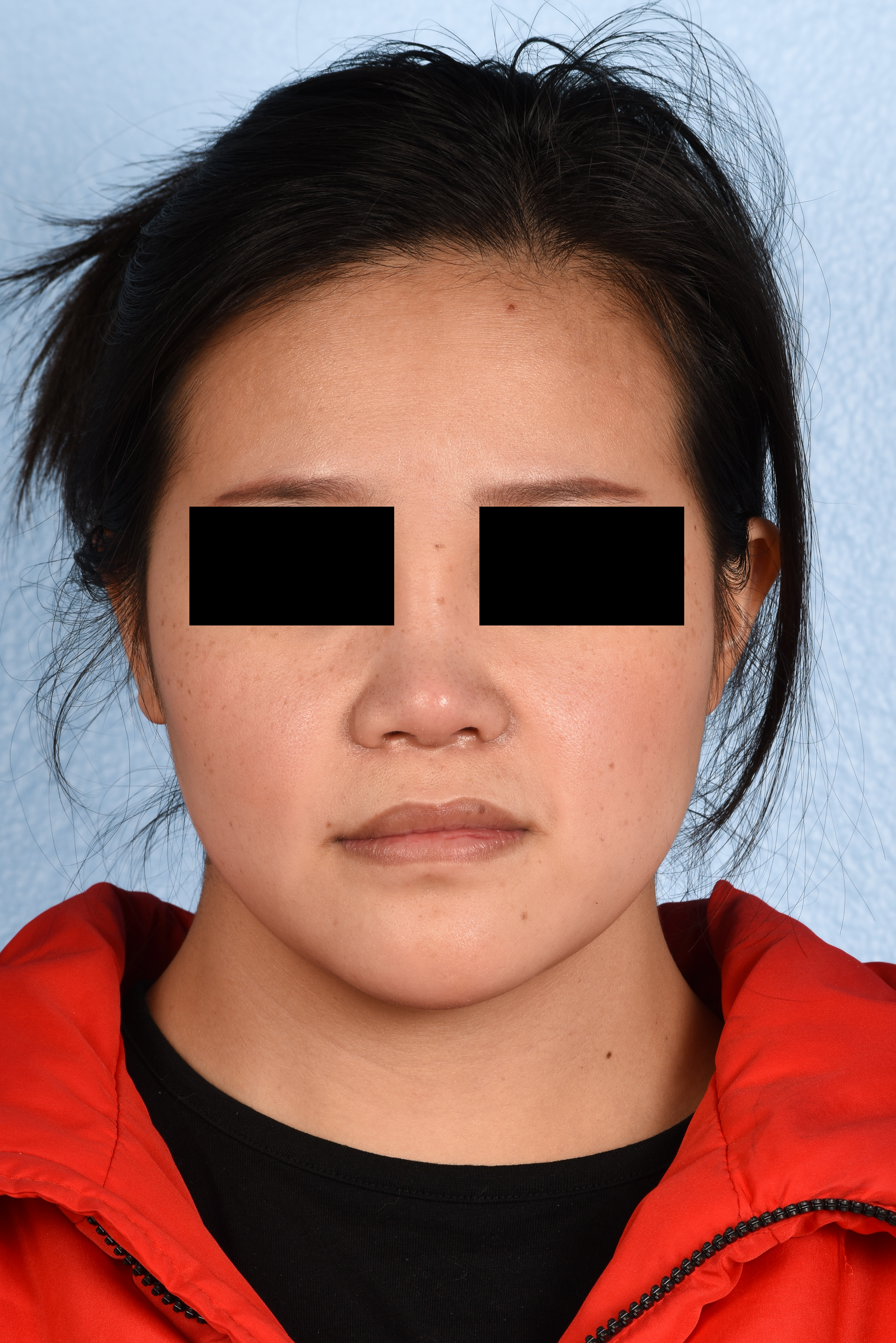Hidden Patients Before & After Gallery - Patient 893076 - Image 6