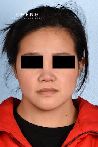 Hidden Patients Before & After Gallery - Patient 893076 - Image 6