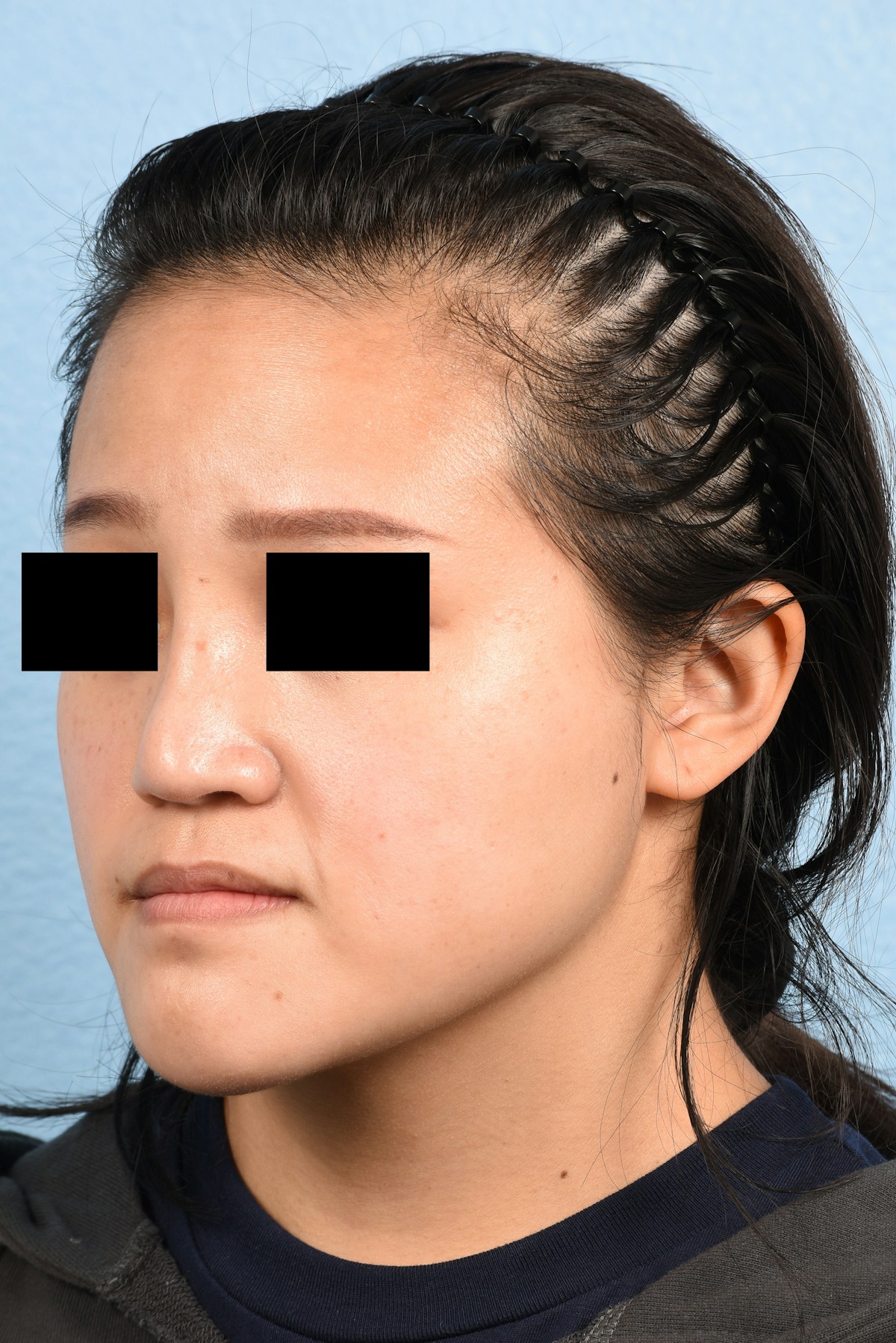 Rhinoplasty Before & After Gallery - Patient 172159 - Image 7