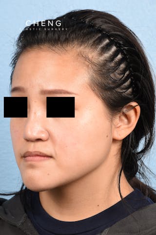 Hidden Patients Before & After Gallery - Patient 893076 - Image 7