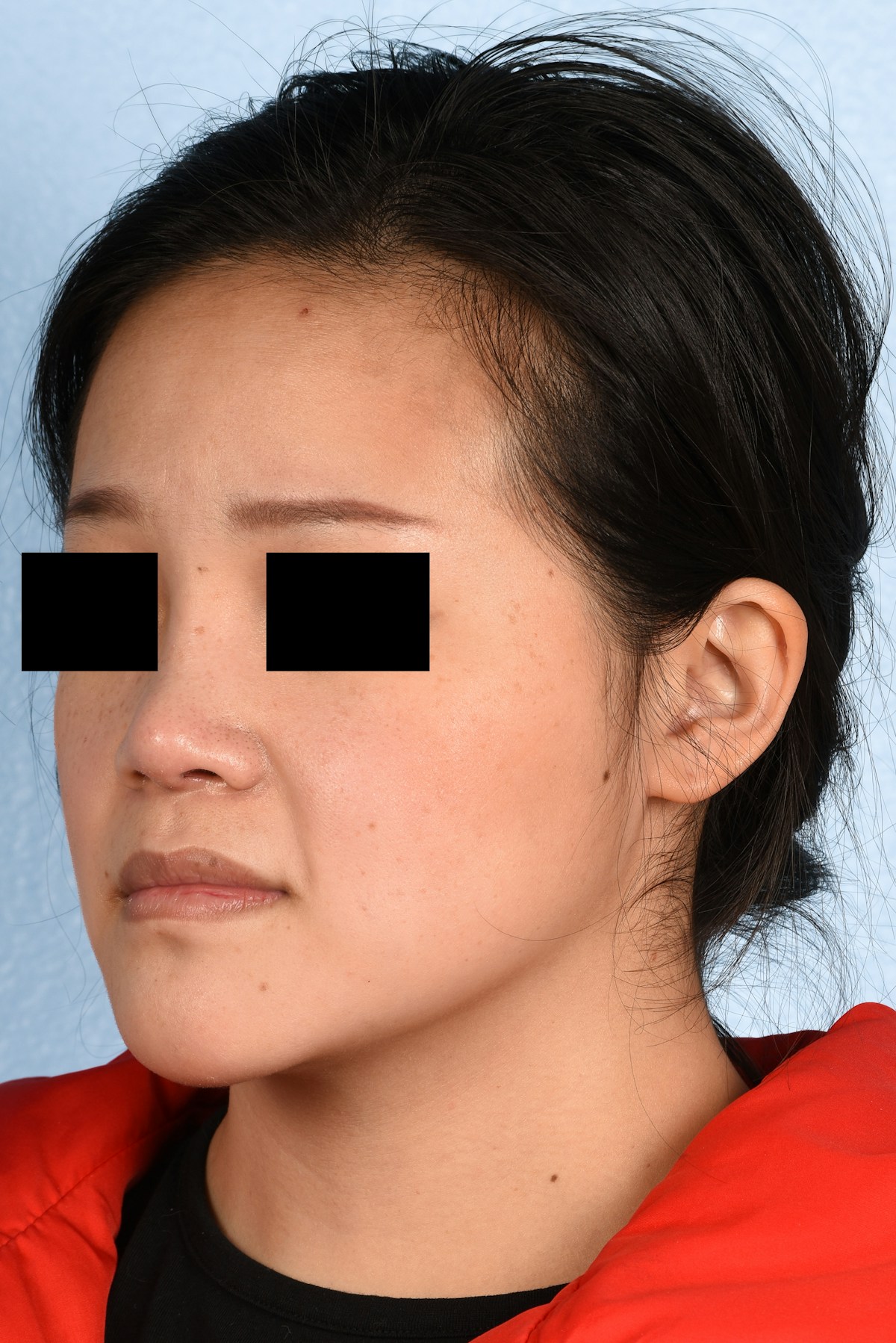 Rhinoplasty Before & After Gallery - Patient 172159 - Image 8