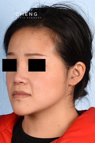 Hidden Patients Before & After Gallery - Patient 893076 - Image 8