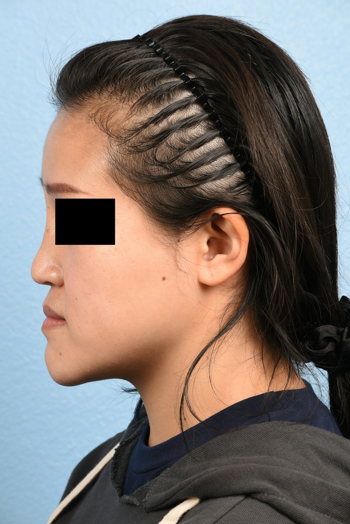 Rhinoplasty Before & After Gallery - Patient 172159 - Image 9