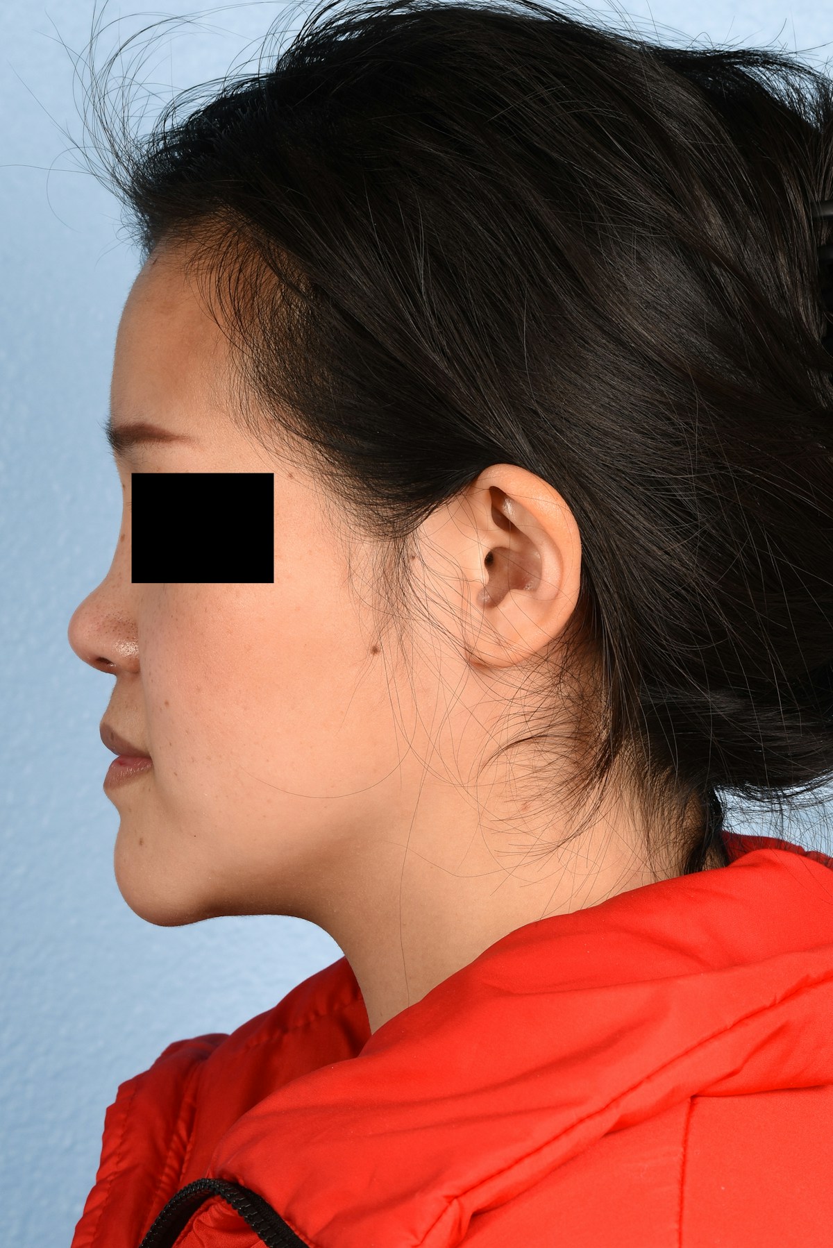 Rhinoplasty Before & After Gallery - Patient 172159 - Image 10
