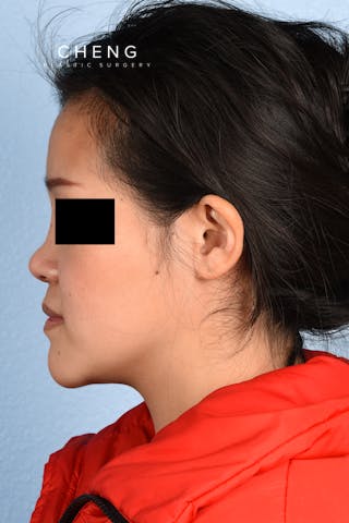 Hidden Patients Before & After Gallery - Patient 893076 - Image 10