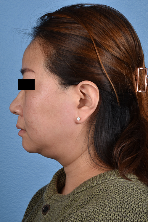 Rhinoplasty Before & After Gallery - Patient 403670 - Image 1
