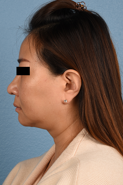 Rhinoplasty Before & After Gallery - Patient 403670 - Image 2