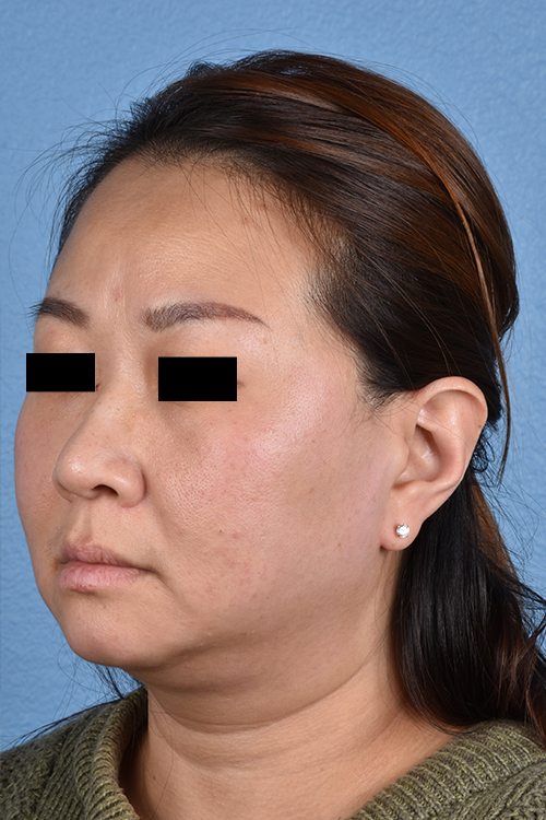 Rhinoplasty Before & After Gallery - Patient 403670 - Image 3