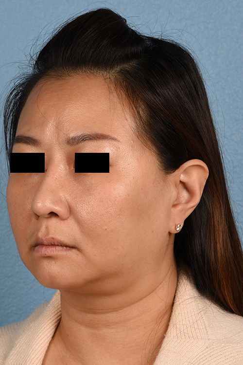 Rhinoplasty Before & After Gallery - Patient 403670 - Image 4