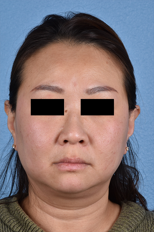 Rhinoplasty Before & After Gallery - Patient 403670 - Image 5