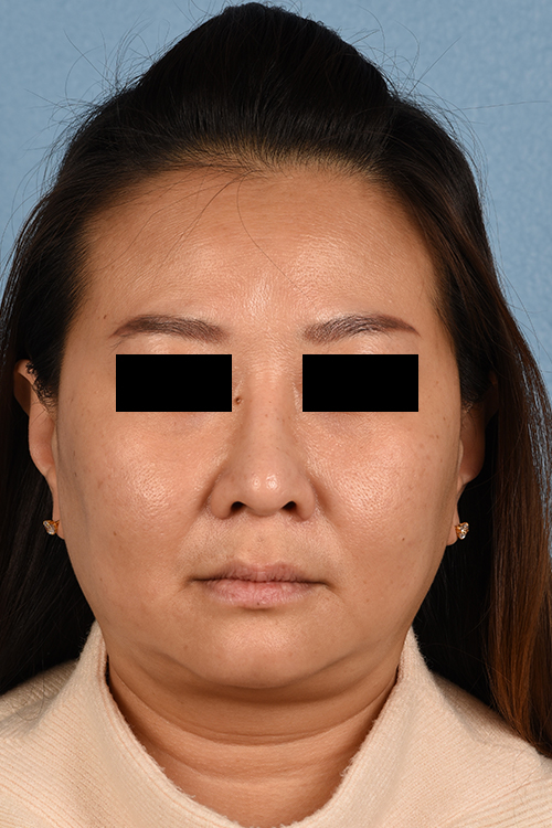 Rhinoplasty Before & After Gallery - Patient 403670 - Image 6