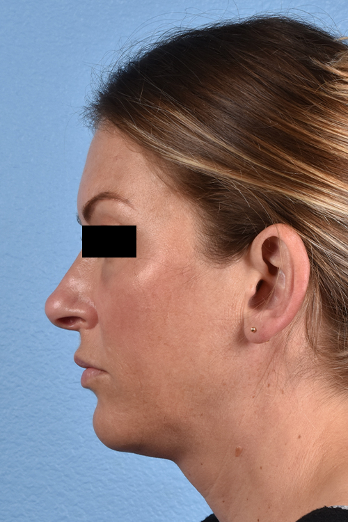 Rhinoplasty Before & After Gallery - Patient 117002 - Image 1