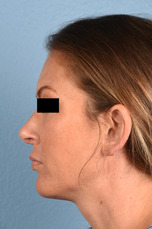 Rhinoplasty Before & After Gallery - Patient 117002 - Image 2