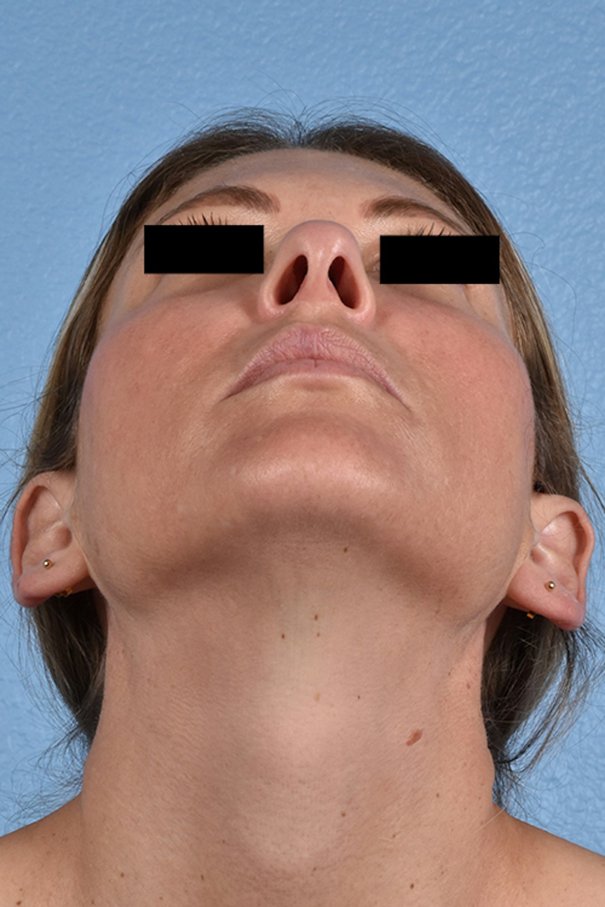 Rhinoplasty Before & After Gallery - Patient 117002 - Image 3