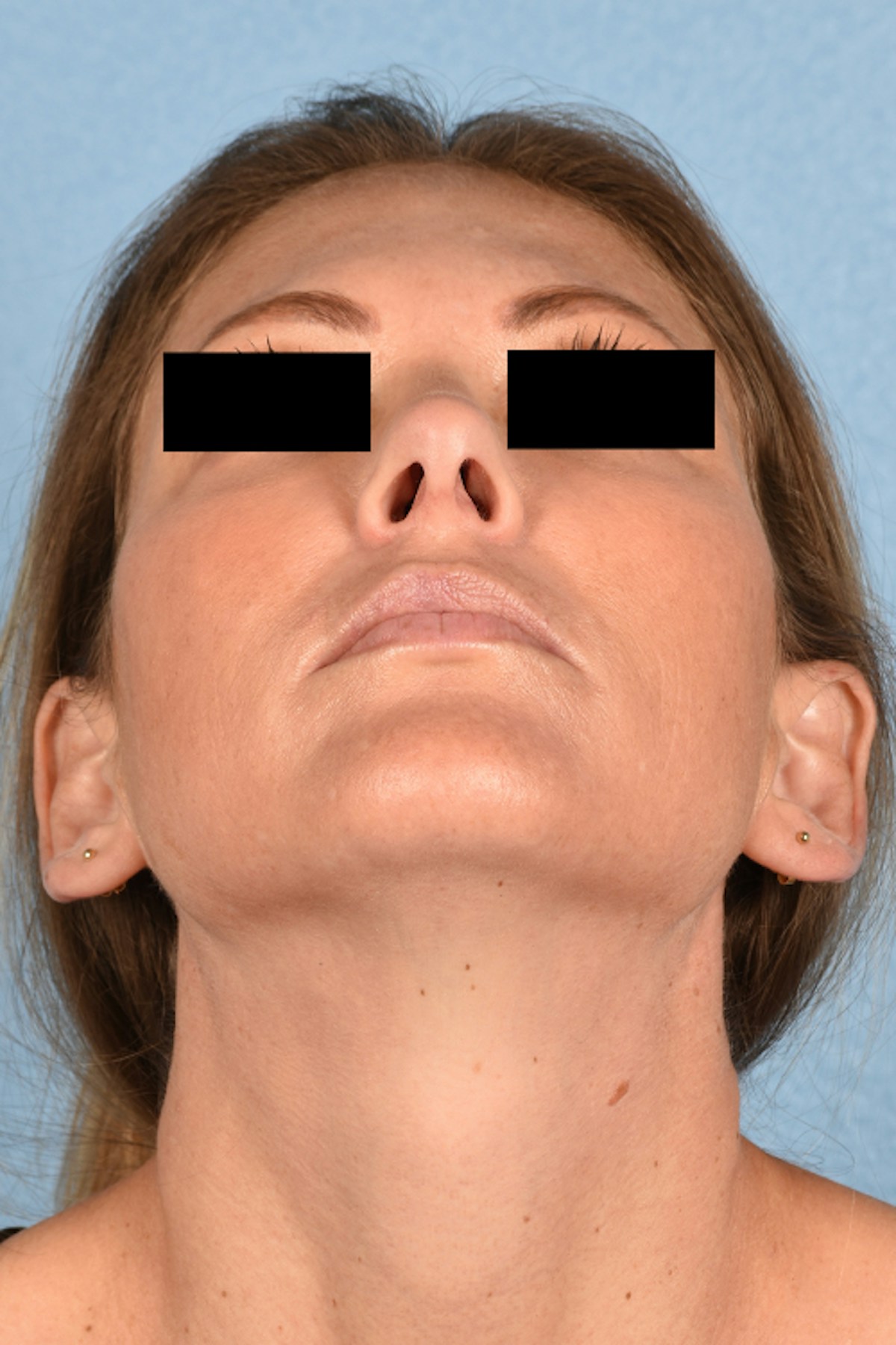 Rhinoplasty Before & After Gallery - Patient 117002 - Image 4