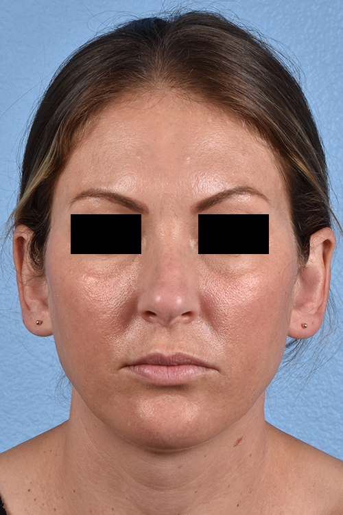 Rhinoplasty Before & After Gallery - Patient 117002 - Image 5