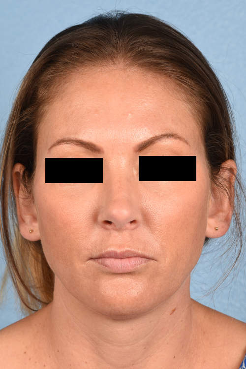 Rhinoplasty Before & After Gallery - Patient 117002 - Image 6
