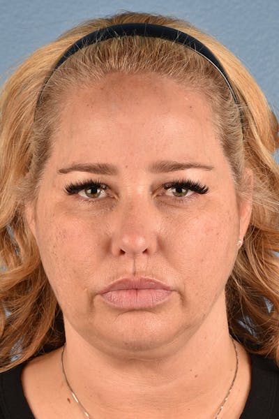 Facelift Before & After Gallery - Patient 171304 - Image 1