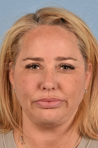 Facelift Before & After Gallery - Patient 171304 - Image 2