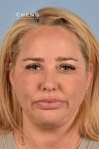 Hidden Patients Before & After Gallery - Patient 411688 - Image 2