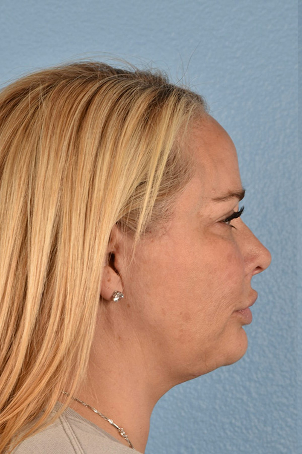 Facelift Before & After Gallery - Patient 171304 - Image 6