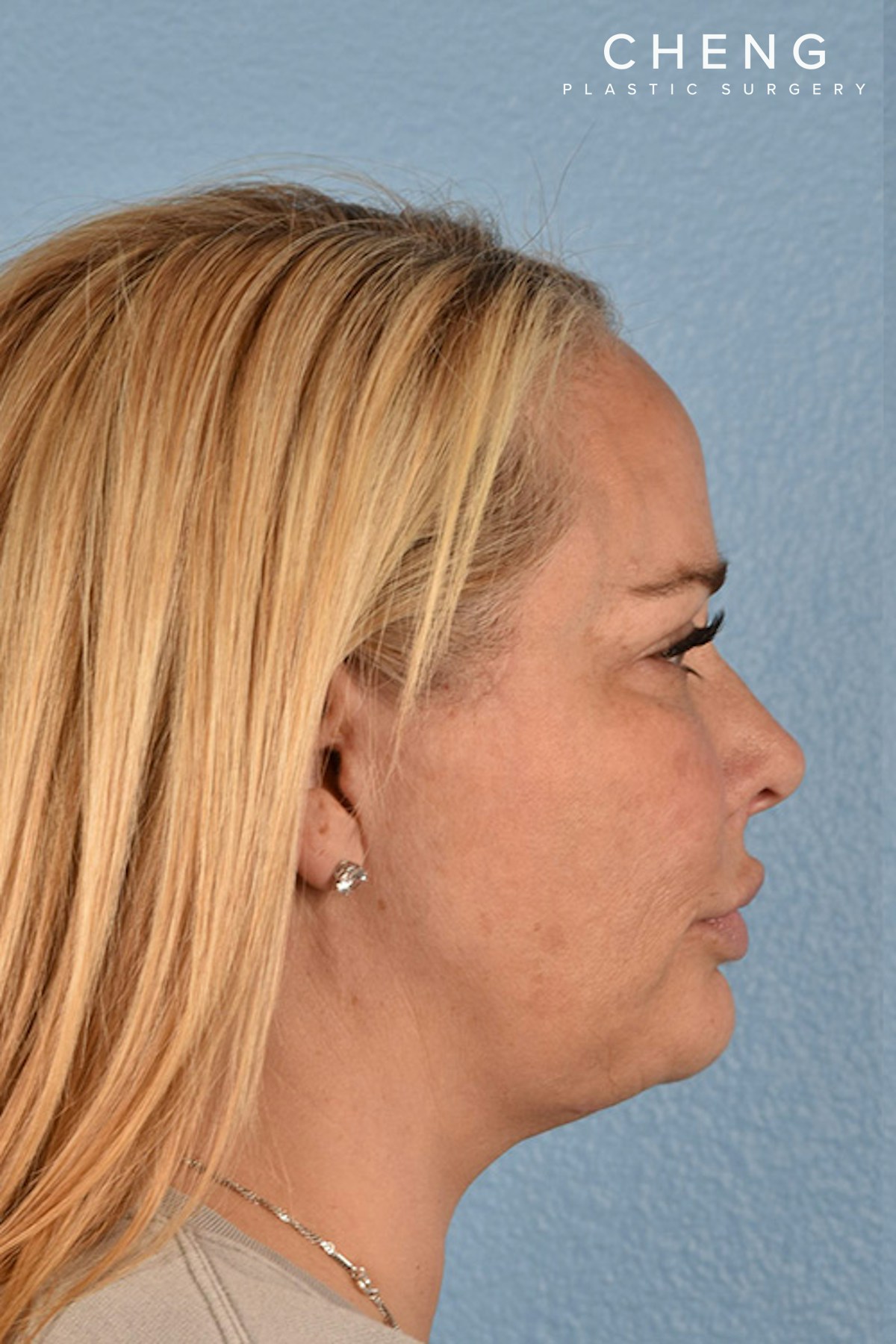 Hidden Patients Before & After Gallery - Patient 231516 - Image 6