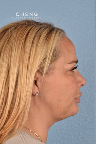 Hidden Patients Before & After Gallery - Patient 411688 - Image 6