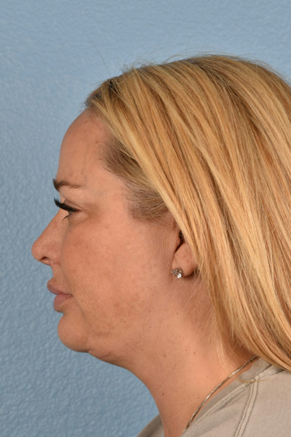 Facelift Before & After Gallery - Patient 171304 - Image 8