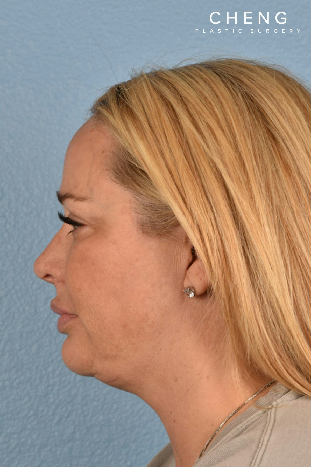 Hidden Patients Before & After Gallery - Patient 231516 - Image 8