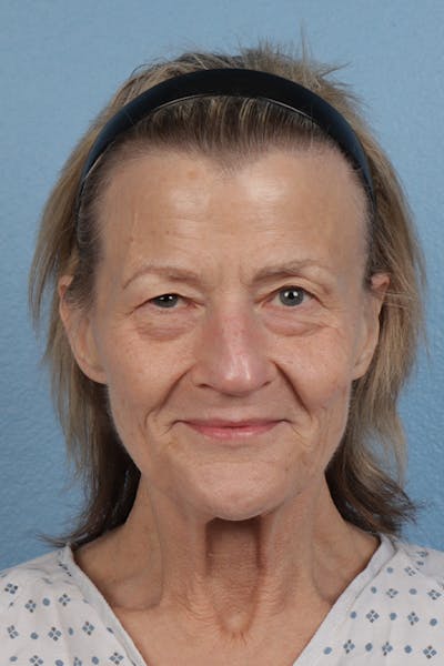 Blepharoplasty Before & After Gallery - Patient 912260 - Image 1