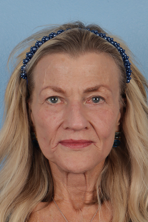 Hidden Patients Before & After Gallery - Patient 277659 - Image 2