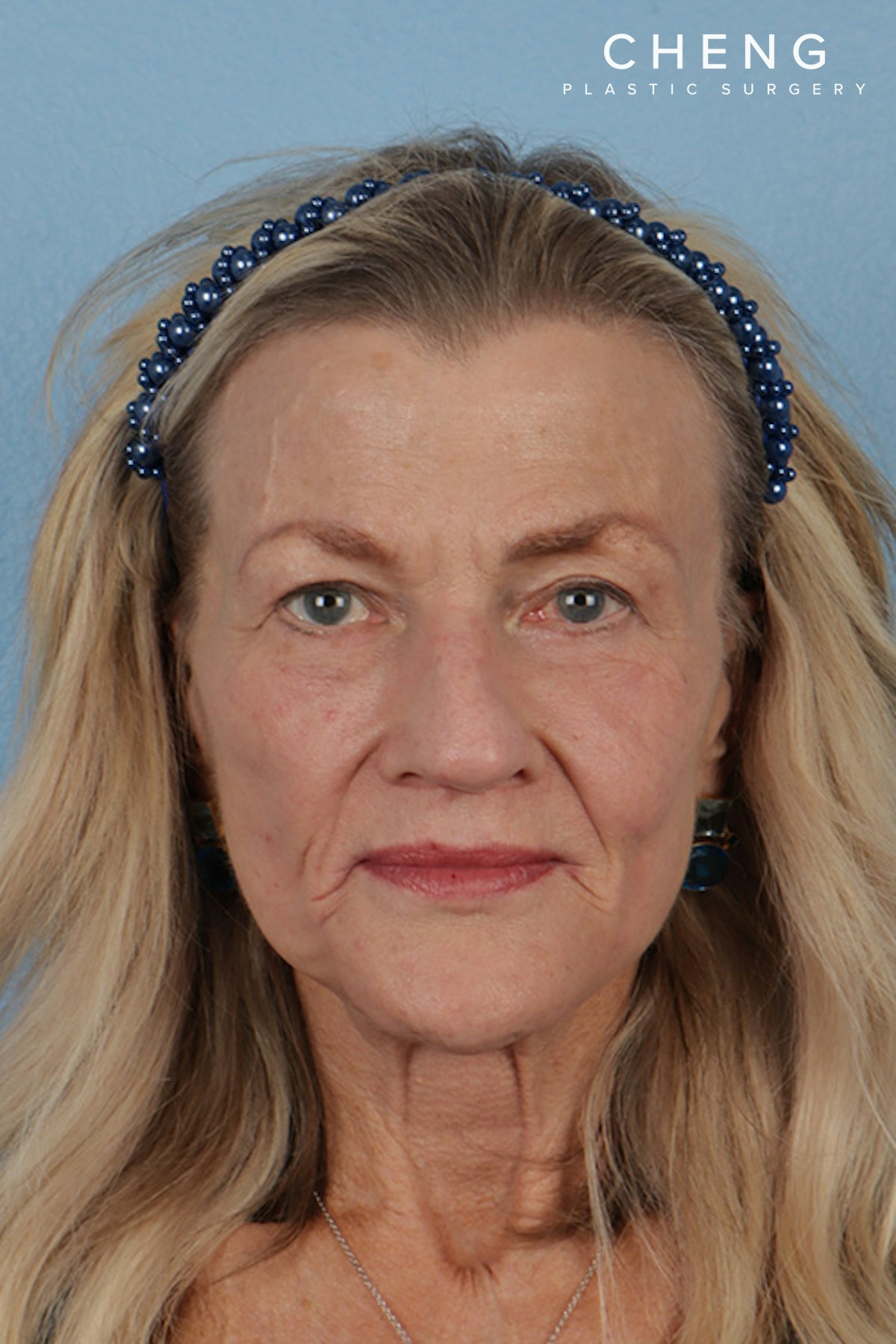 Hidden Patients Before & After Gallery - Patient 277659 - Image 2