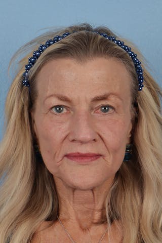 Hidden Patients Before & After Gallery - Patient 277659 - Image 2