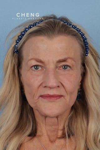 Hidden Patients Before & After Gallery - Patient 315045 - Image 2