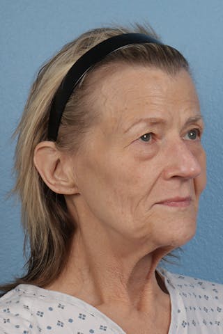 Hidden Patients Before & After Gallery - Patient 277659 - Image 3