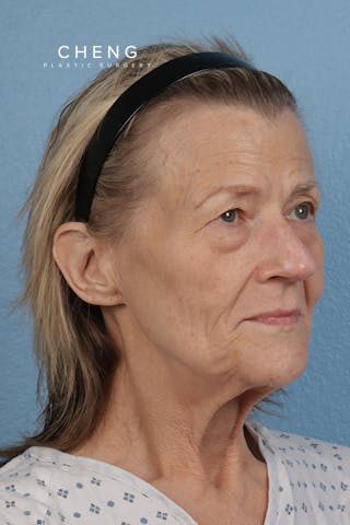 Hidden Patients Before & After Gallery - Patient 315045 - Image 3