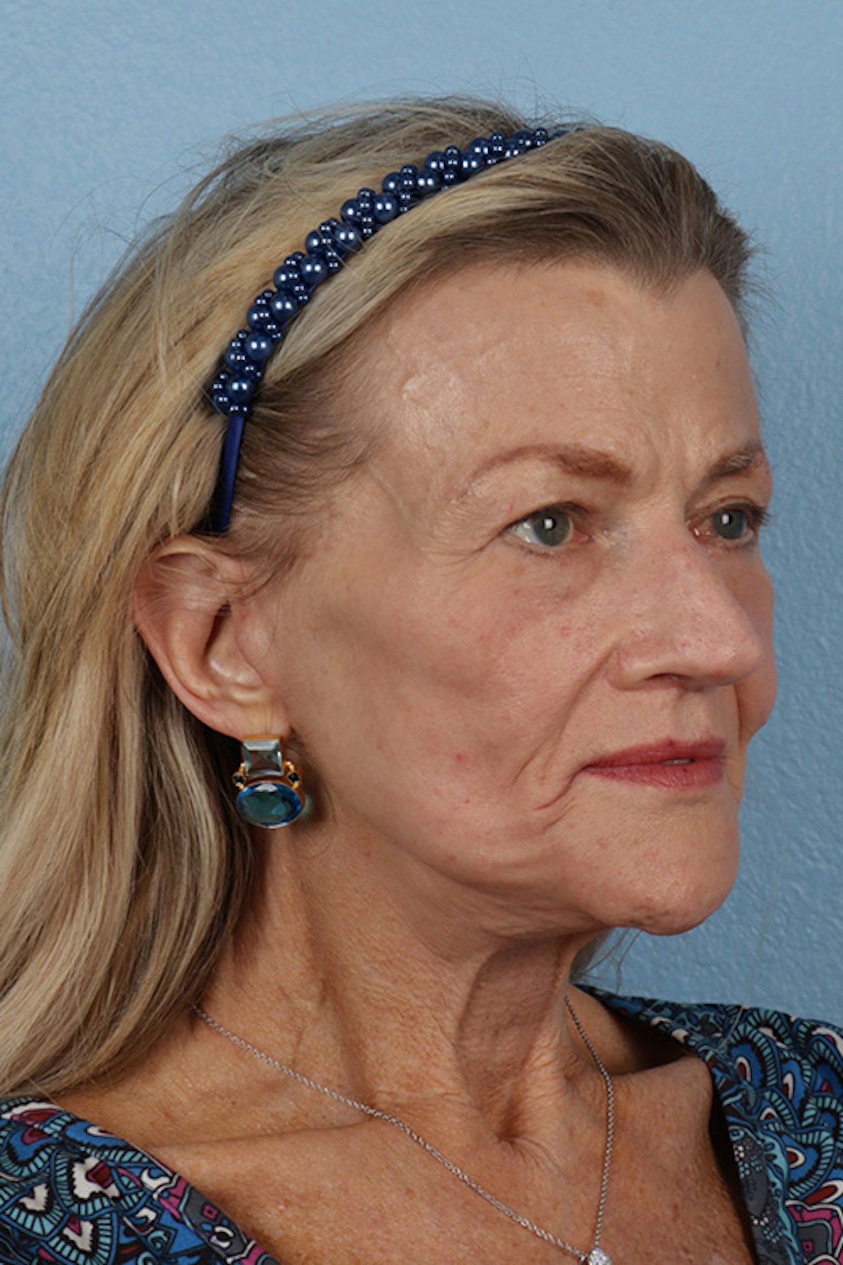 Fat Transfer Before & After Gallery - Patient 304134 - Image 4
