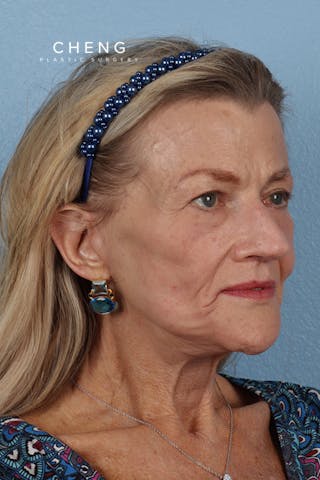 Hidden Patients Before & After Gallery - Patient 315045 - Image 4