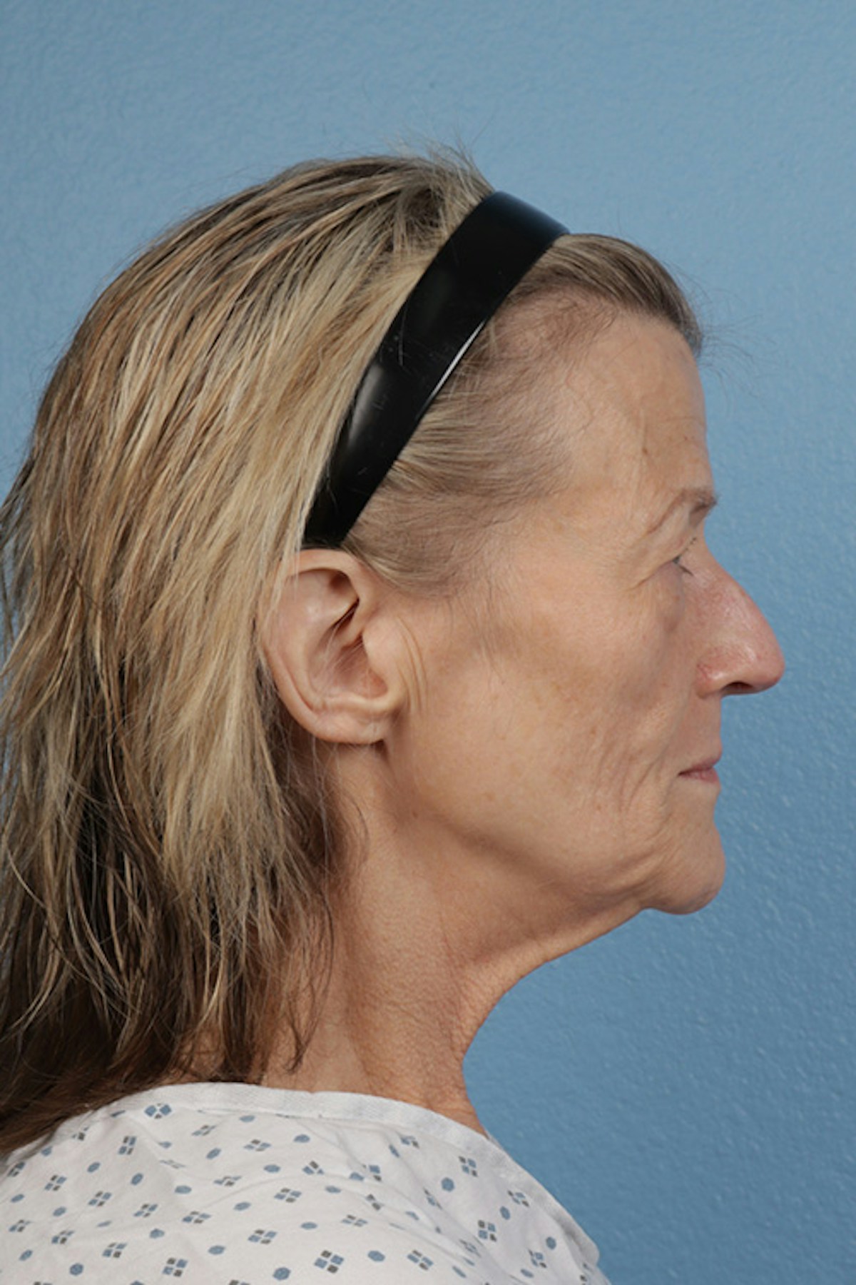 Fat Transfer Before & After Gallery - Patient 304134 - Image 5