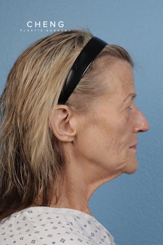 Hidden Patients Before & After Gallery - Patient 315045 - Image 5